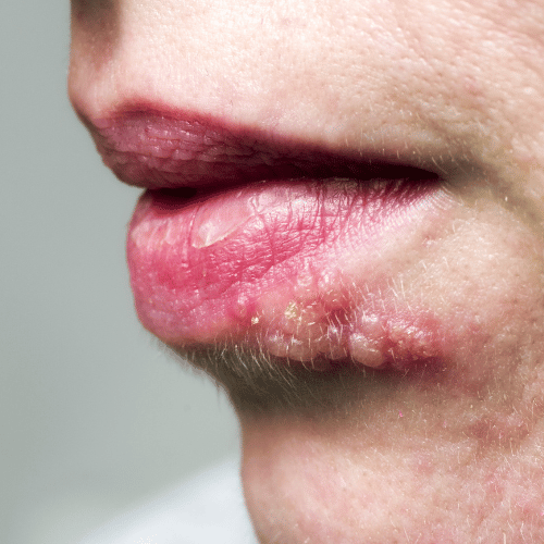 Herpes Simplex vírus